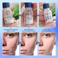 fresh Dr.Leo Acne Essence Salicylic Acid Anti-acne formula Lighten Acne Scars ac