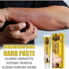 Psoriasis Ointment Skin Care Cream for Relieve Itching, Inhibit Fungal Infection