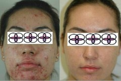 10%-20%-30%-40%-50% Glycolic Acid Cream 0.4ozX5/2oz For Acne/Scar/Clogged Pores